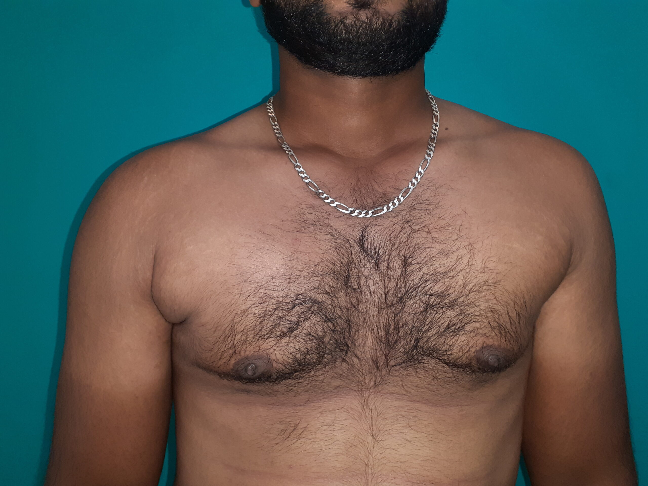 After — Grade II - Gynecomastia - Stage 2