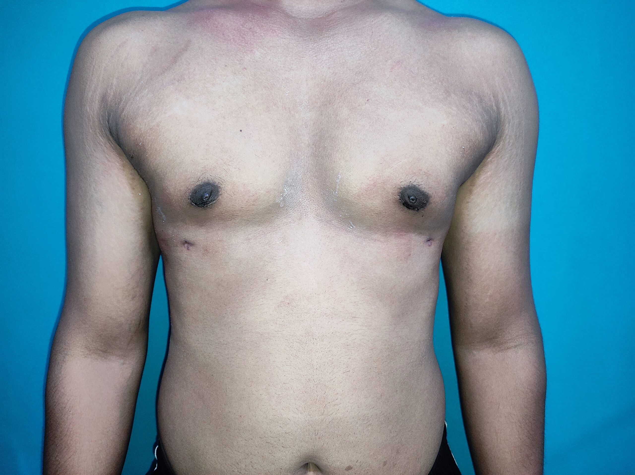 After — Gynecomastia - Stage 1
