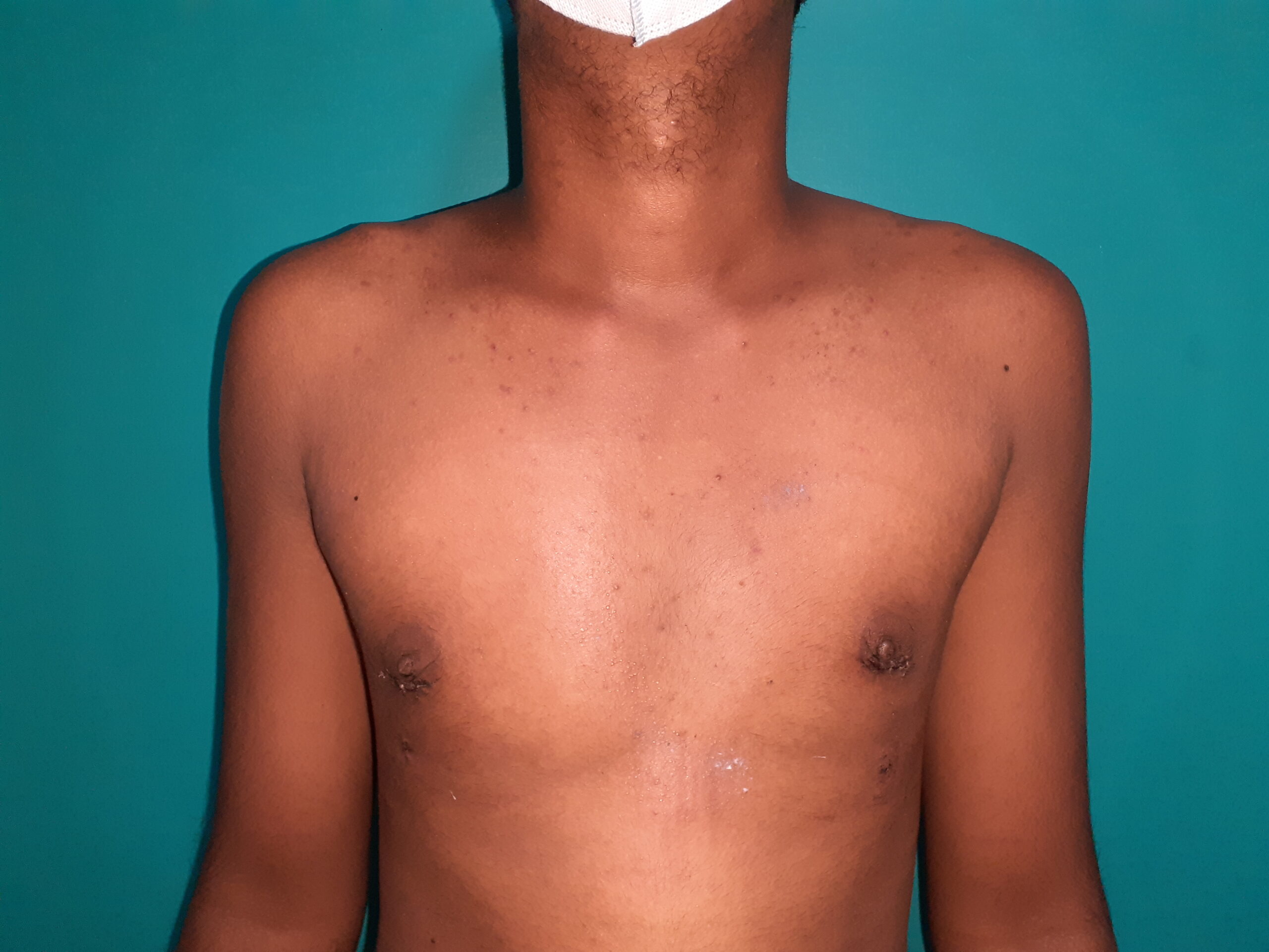 After — Puffy Nipple - Gynecomastia - Stage 1