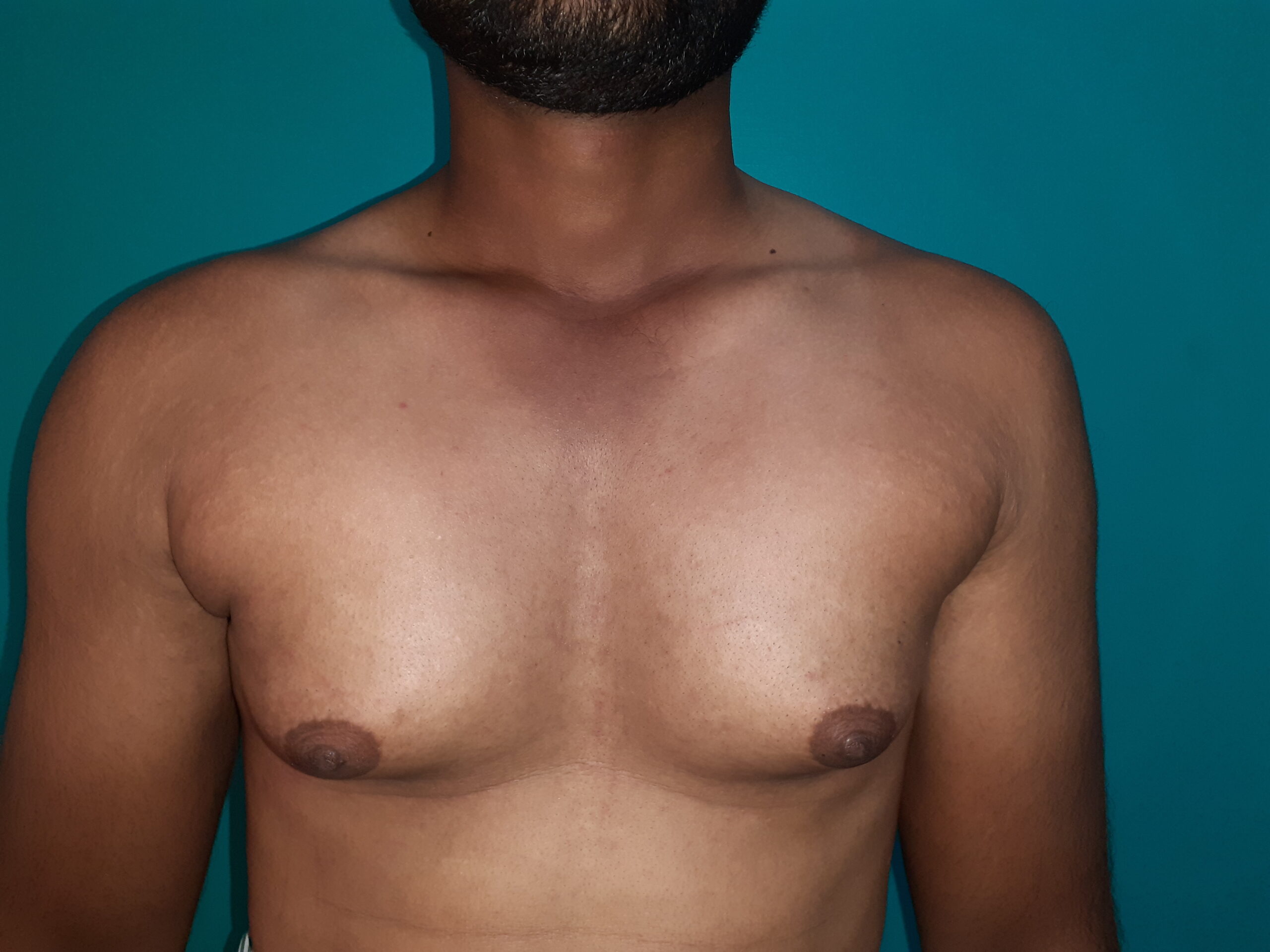 Before — Grade II - Gynecomastia - Stage 2