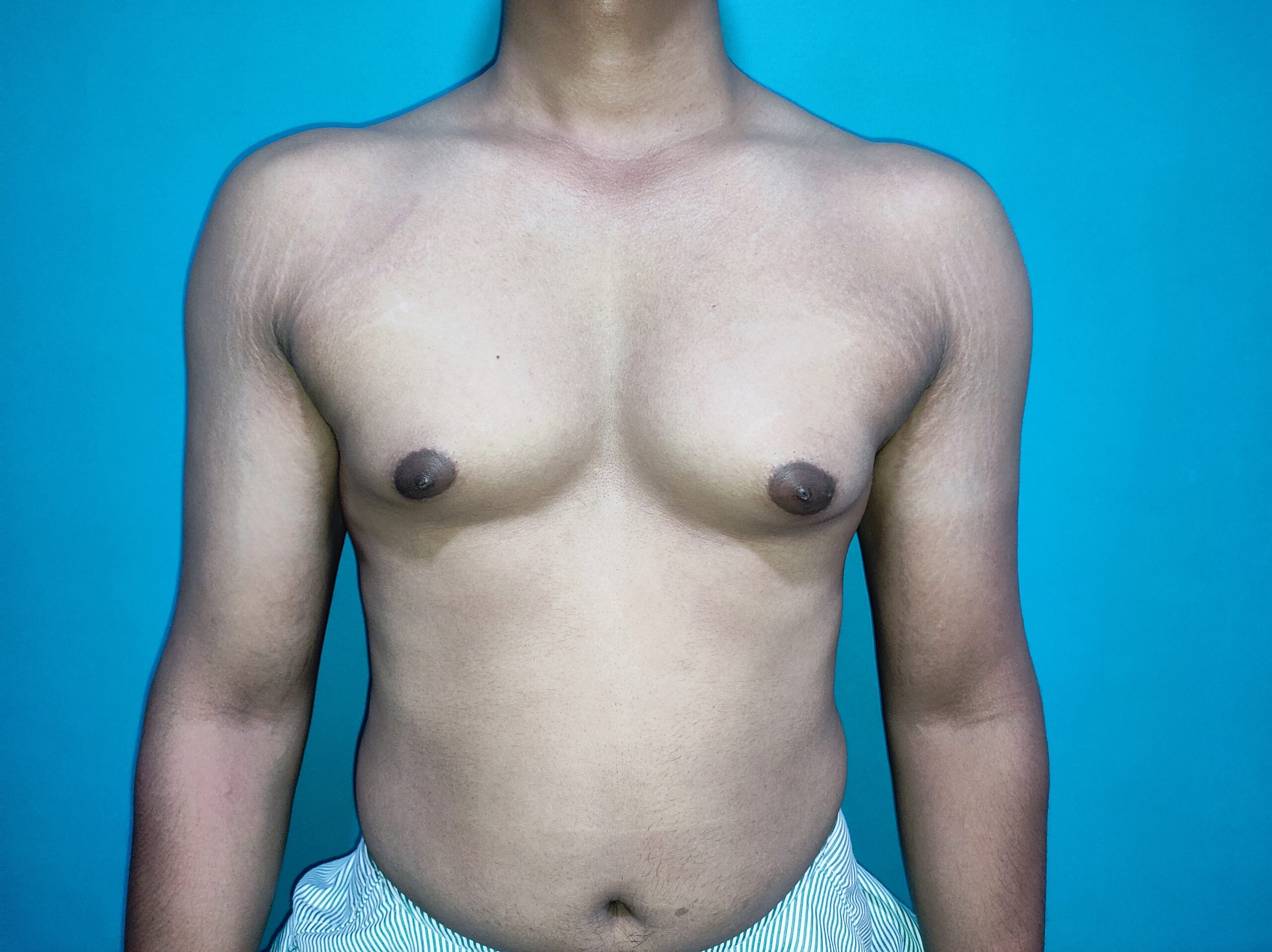 Before — Gynecomastia - Stage 1
