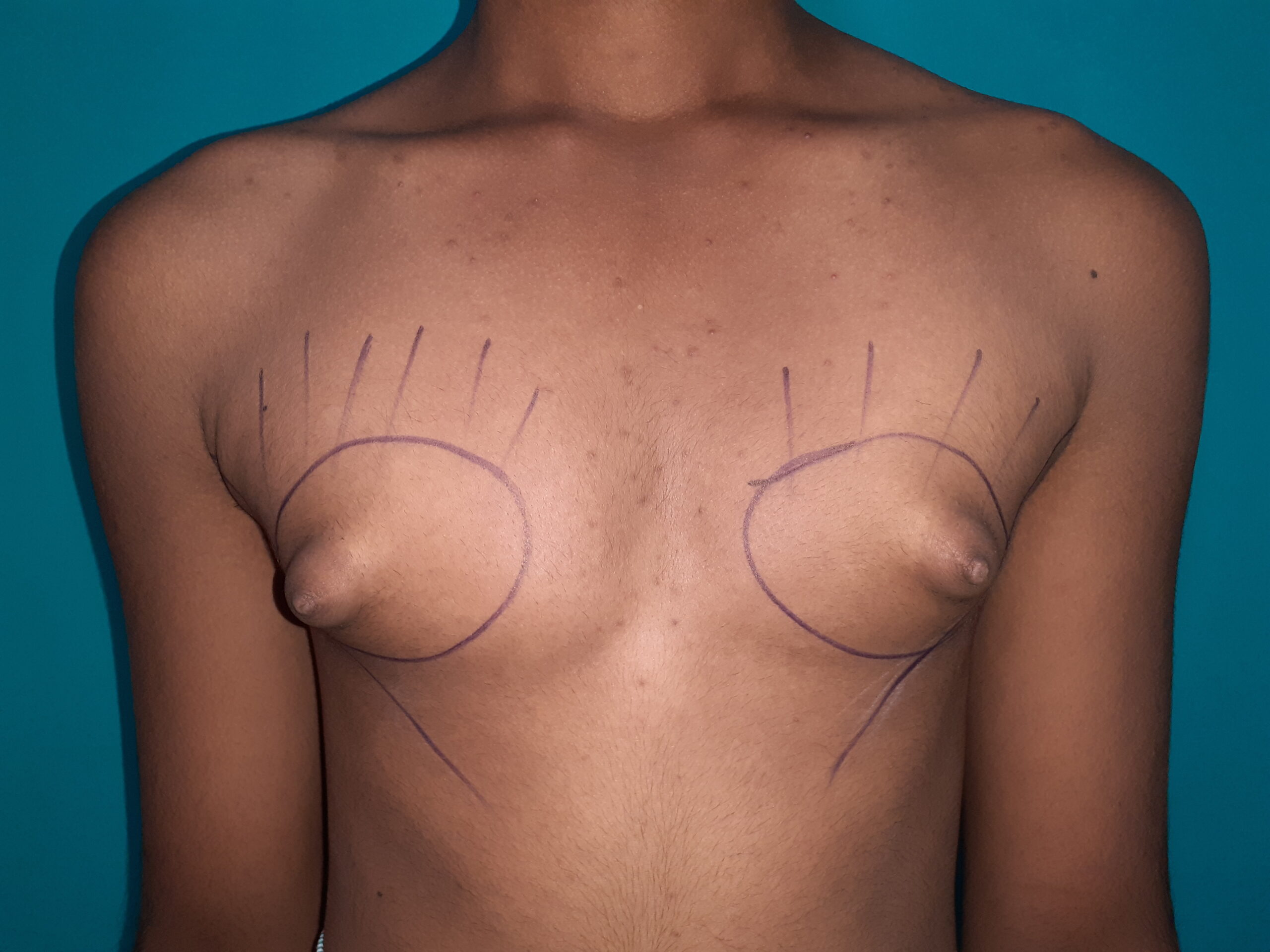 Before — Puffy Nipple - Gynecomastia - Stage 1