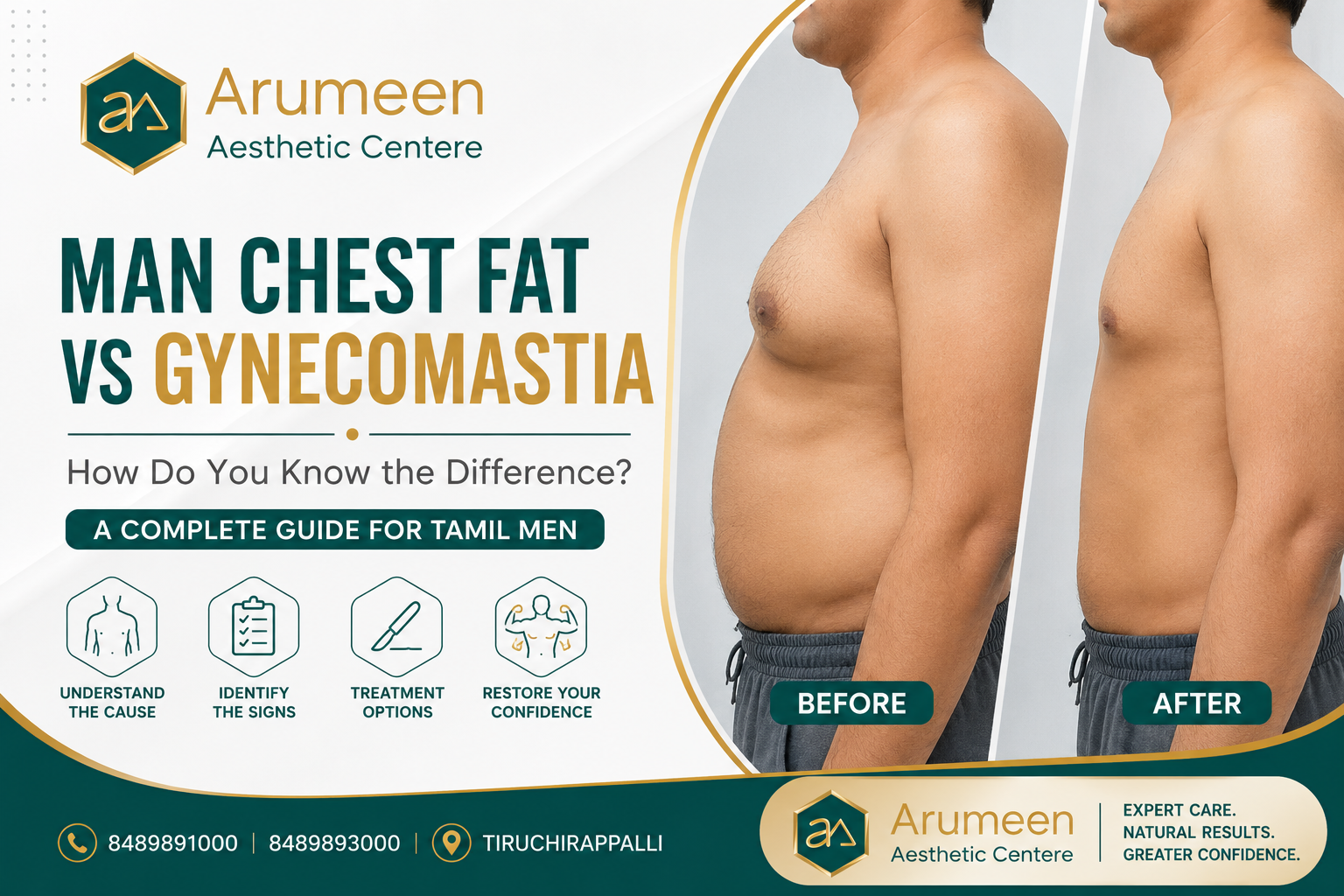 What is gynecomastia? A complete guide for men